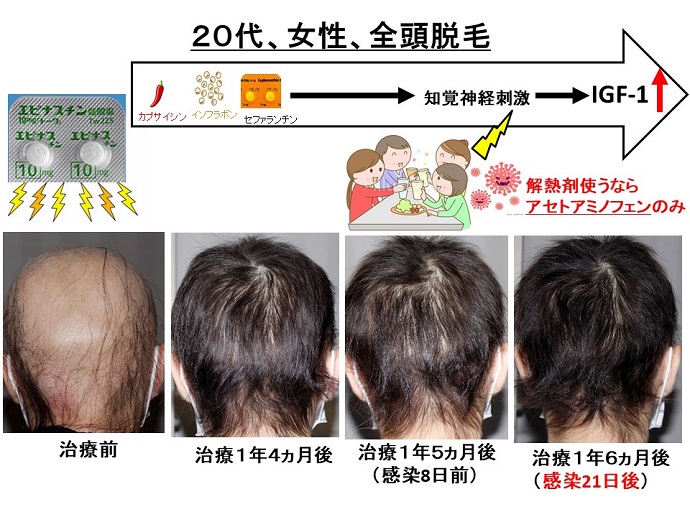 円形脱毛症　病院